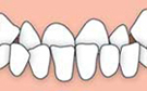 Anterior crossbite