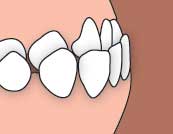 Class III malocclusion