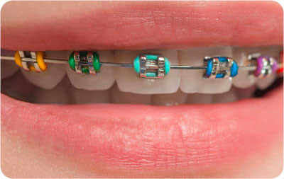 Insignia™ braces