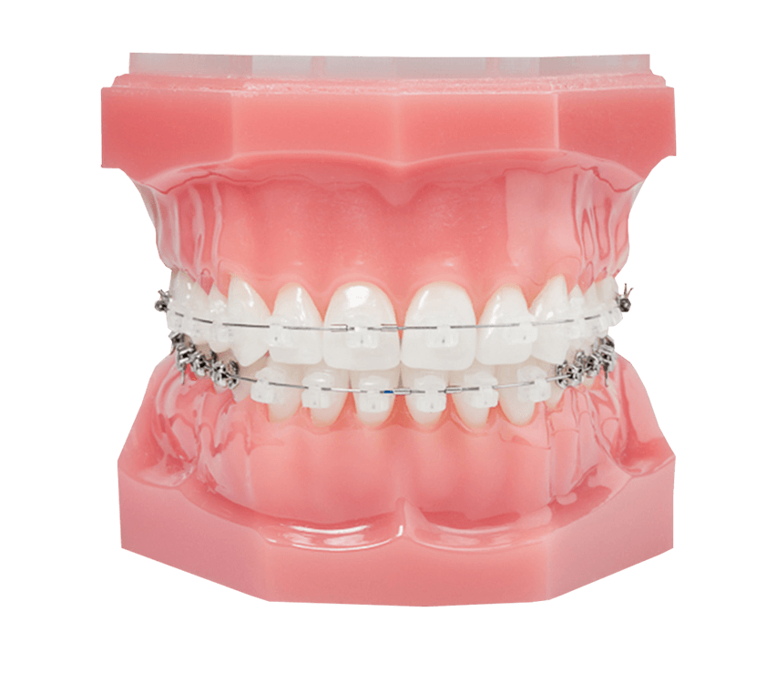 Ceramic Braces, Discreet Braces in Yorkshire