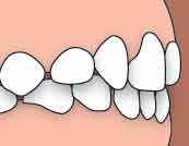 Class 1 Malocclusion