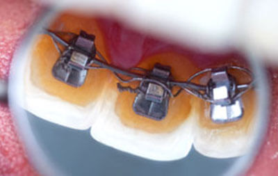 Invisalign Teen