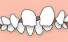 Diastema