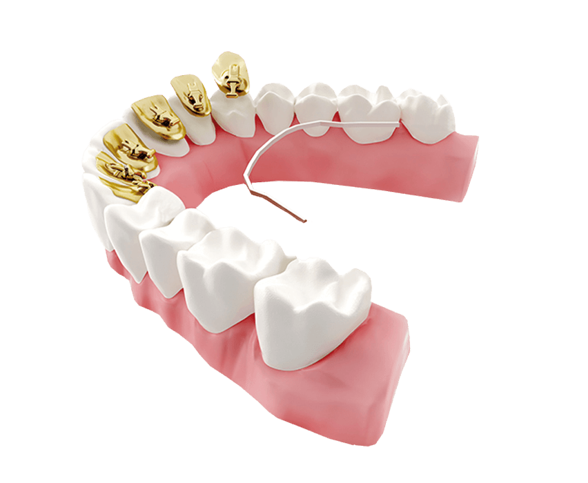 Lingual Braces Incognito™ Braces Yorkshire Trinity House Orthodontics