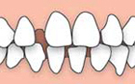 Diastema