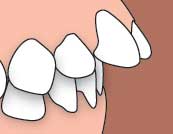 Class II division 1 malocclusion