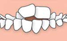 Posterior crossbite