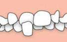 Anterior crossbite