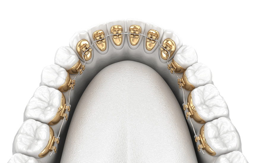 Lingual Braces Incognito™ Braces Yorkshire Trinity House Orthodontics